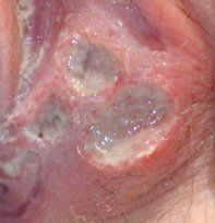 Ulcer On Vulva Xxx Sex Images