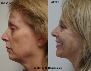 best of Hopping facial surgeon Dr